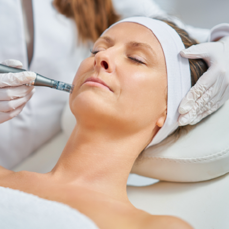 Microneedling Therapy